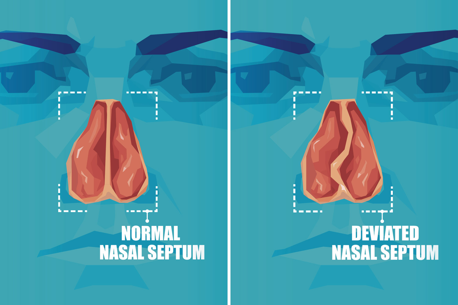 Vector cross section of human face with deviated and normal nasal septum