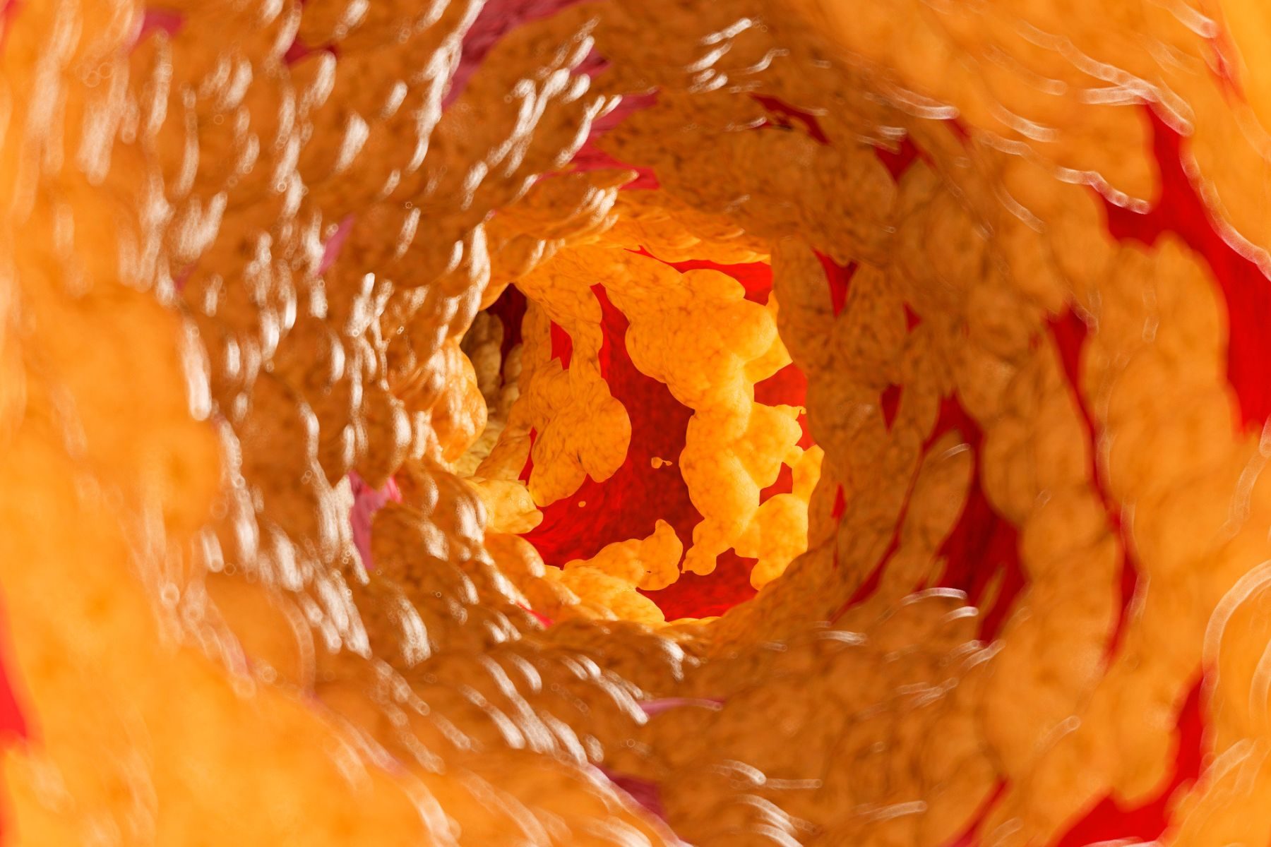 An illustration of fat inside an artery