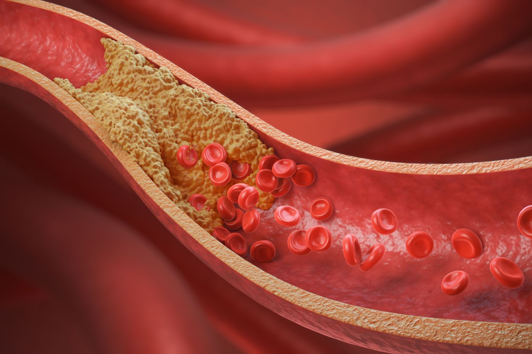 An illustration of an artery with plaque build-up