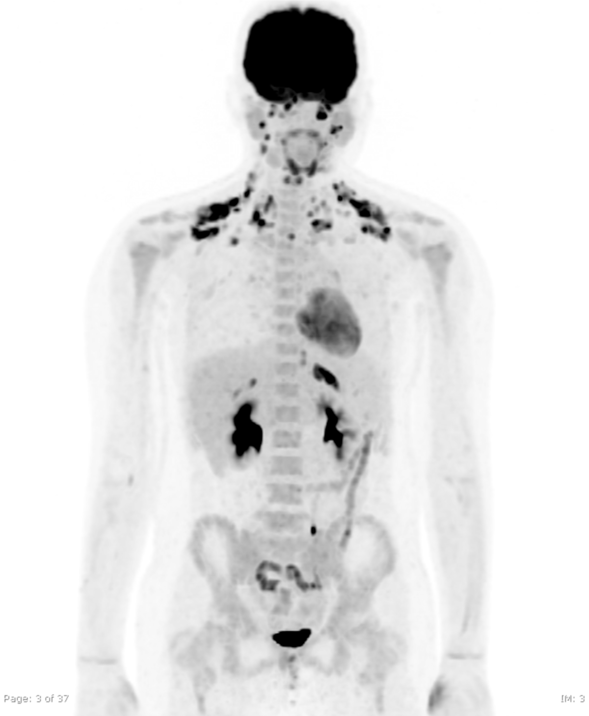 This PET-CT scan shows glucose-burning brown fat around the neck, collarbone and abdomen (the brain also lights up due to its normal high glucose use)