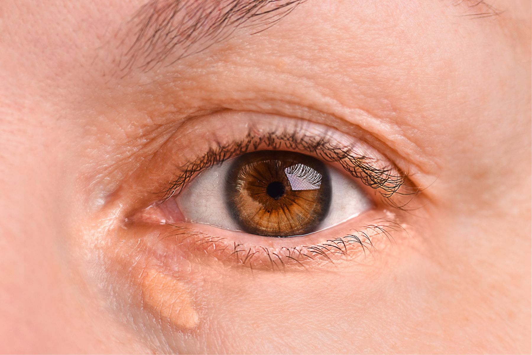 A closeup of a brown eye, with a xanthelasma underneath