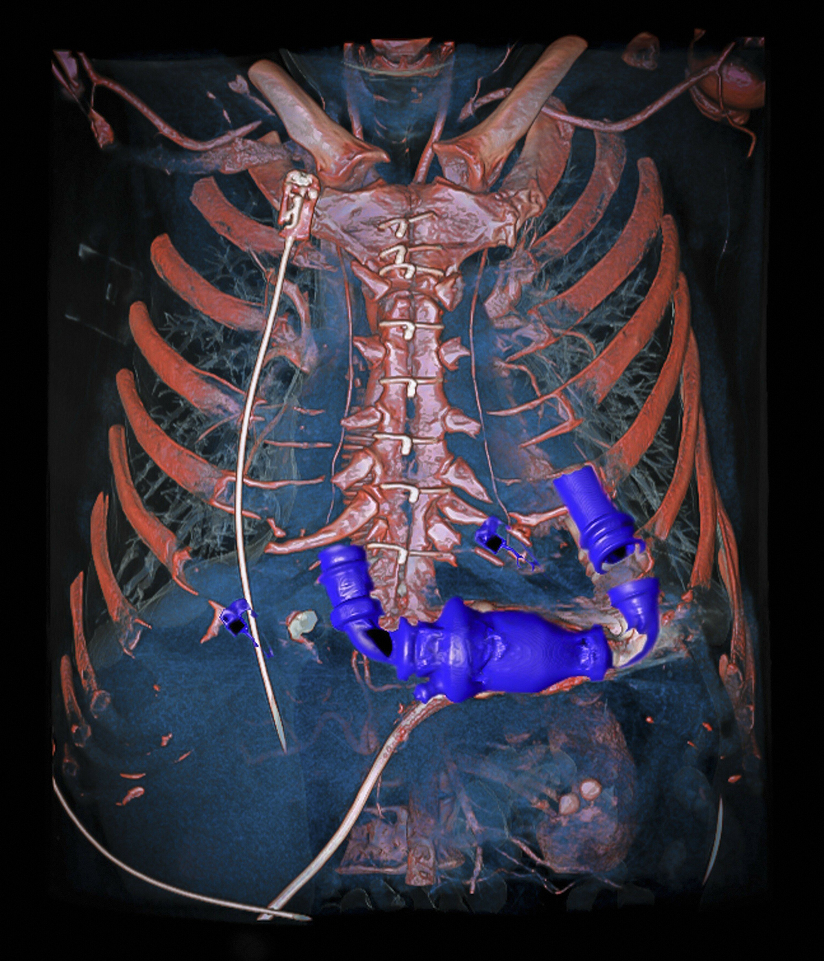Scan of human chest cavity with blue heart pump.