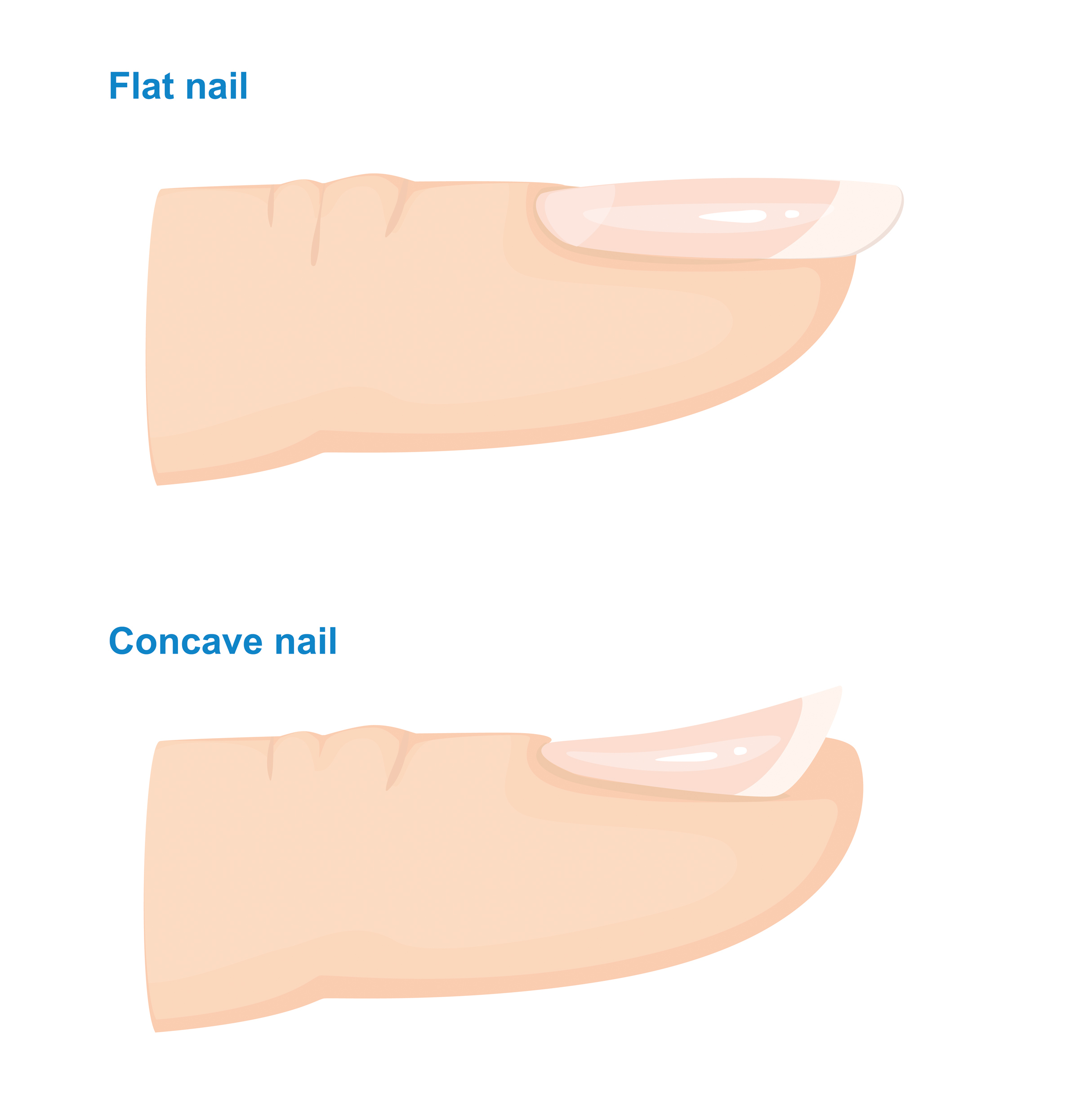 A healthy nail and a concave nail