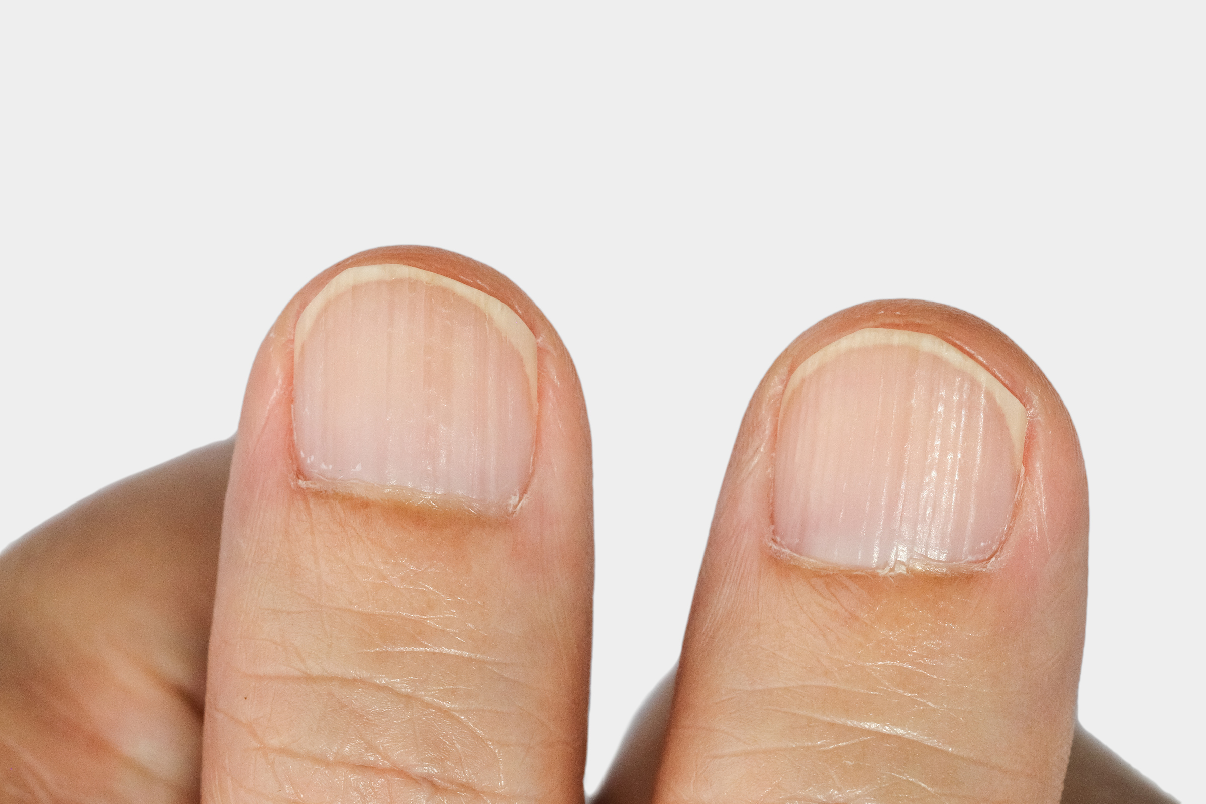 Vertical ridges on the fingernails symptoms deficiency vitamins and minerals