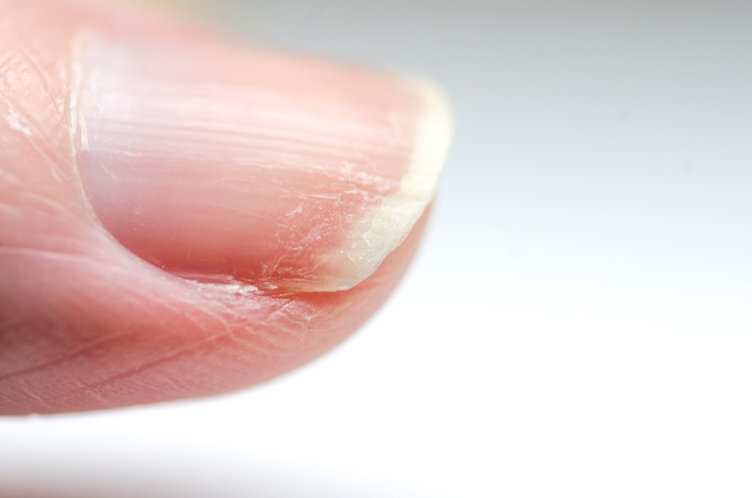 Close-up of brittle nails. Damage to the nails after using polish. Peeling on the nails. Damage to the nail. Shattered nails.