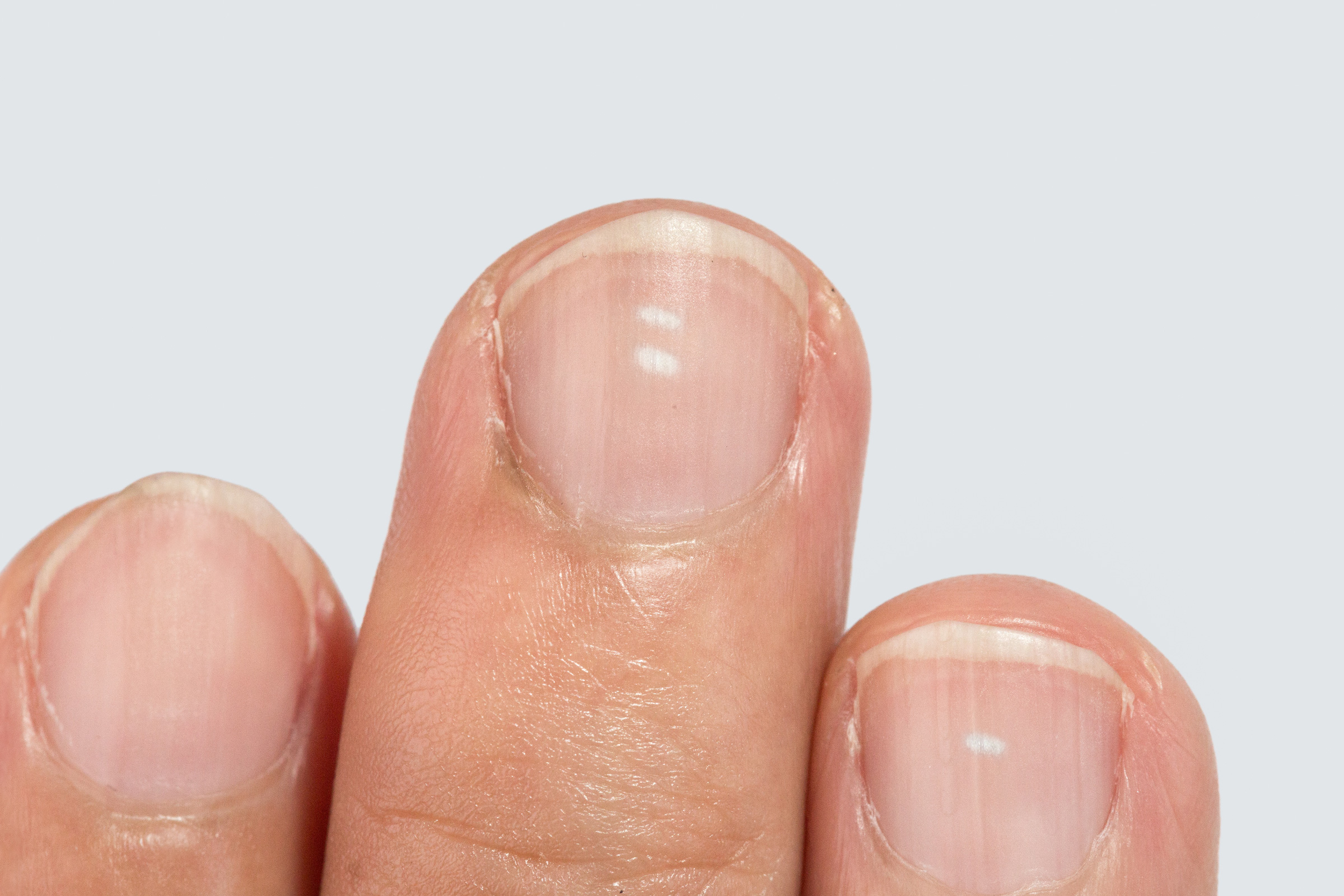 White spots on fingernails