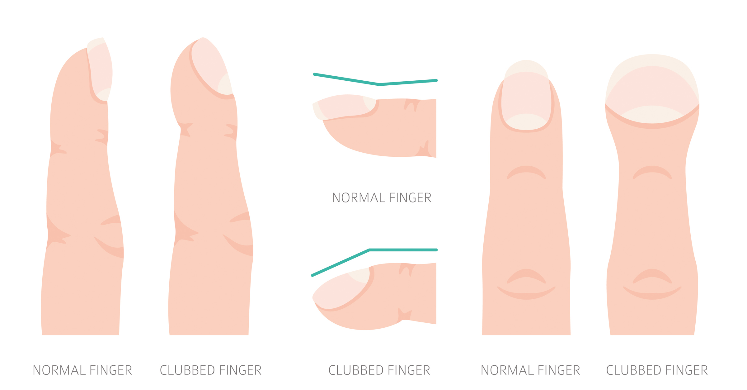 Clubbed fingernails