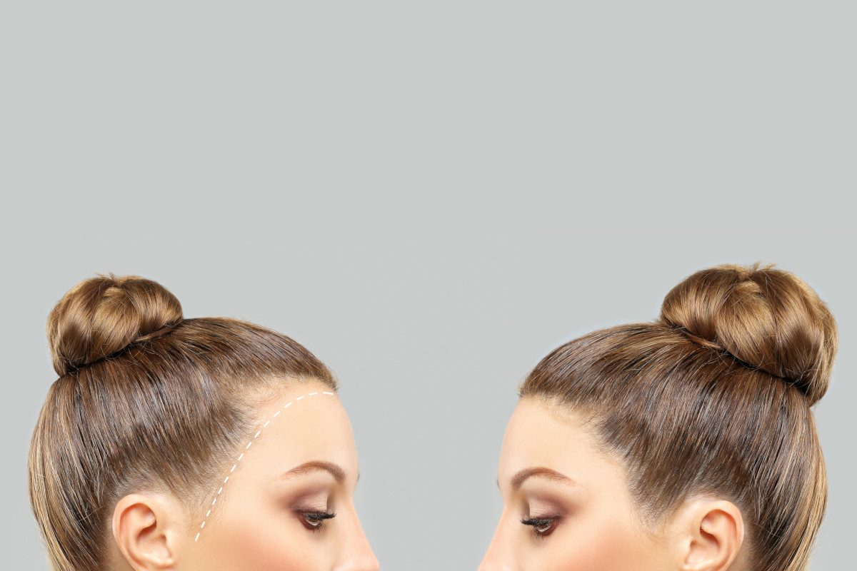 Photo showing a before and after of a person's hairline after treatment for FFA