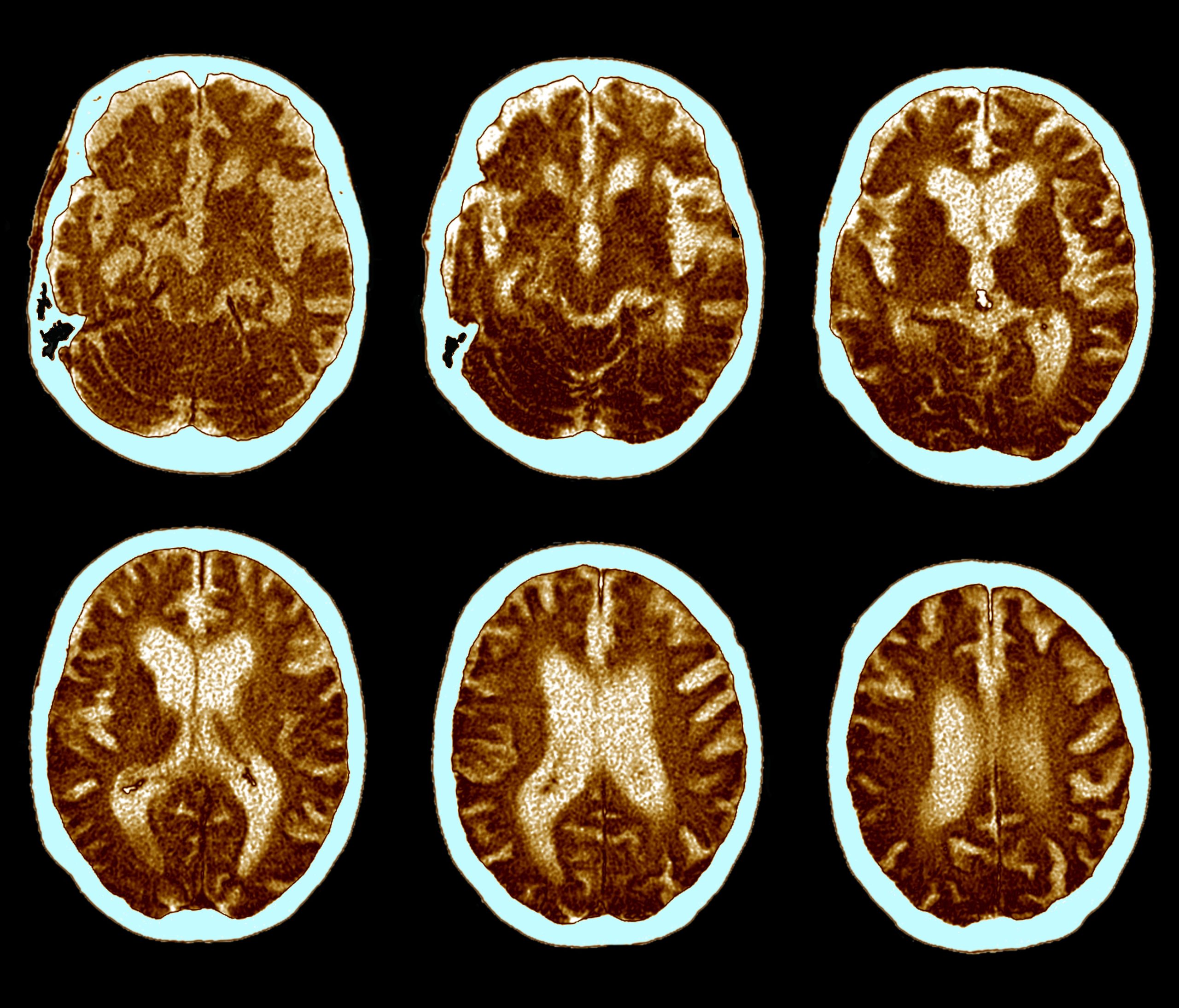 CAT scan of brain