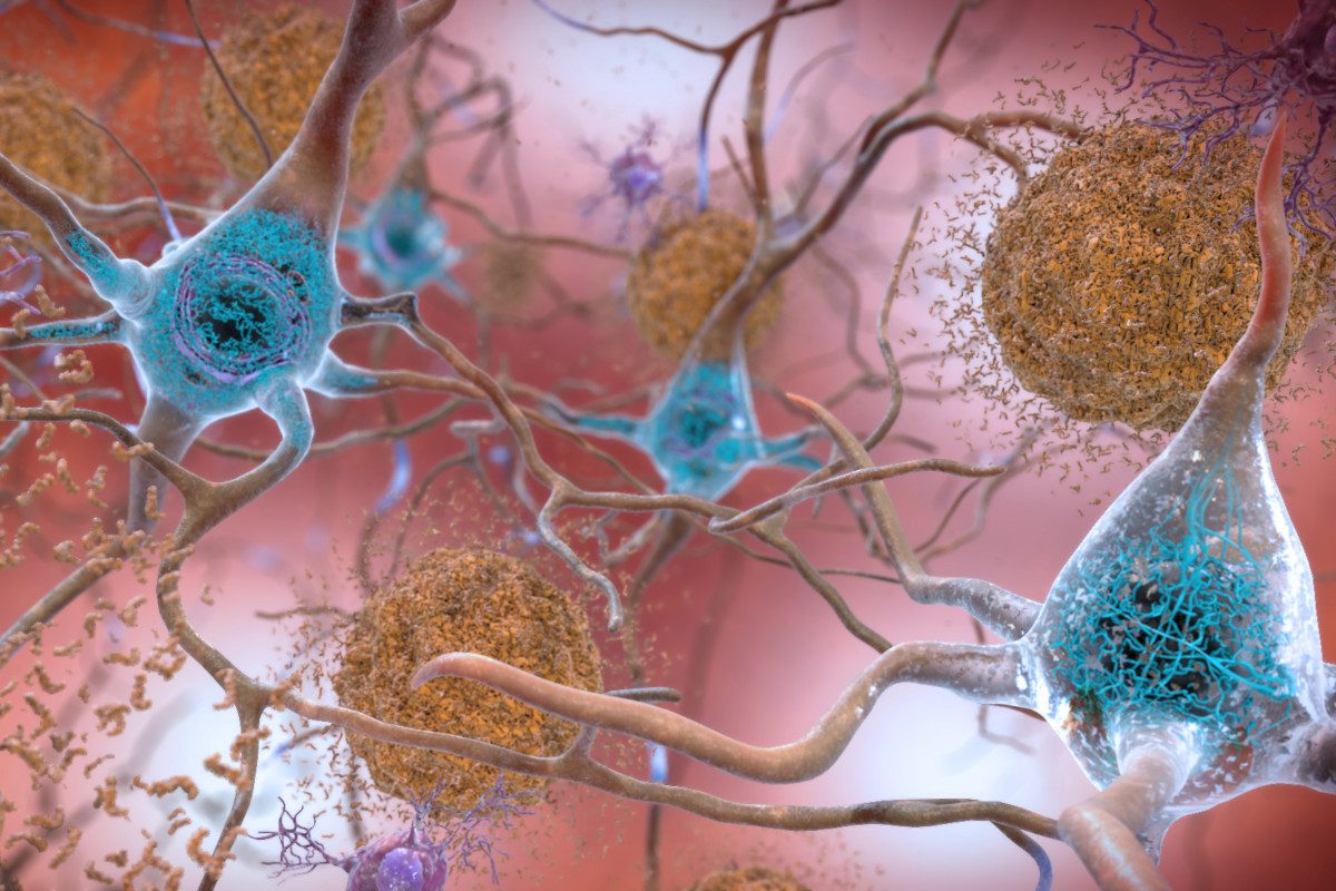 Abnormal collections of tau proteins become tangled (blue) within neurons, harming the communication between them