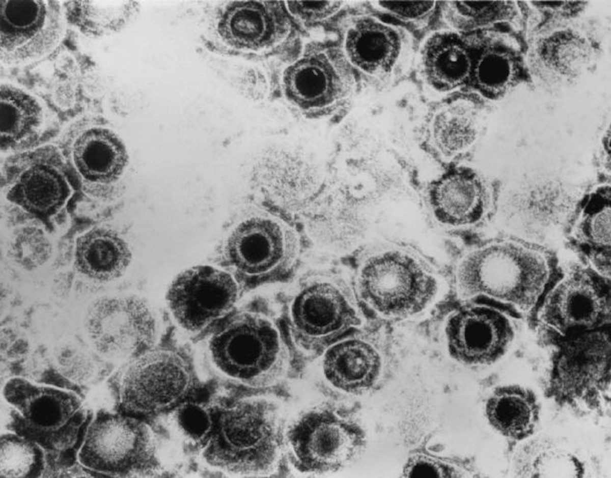 Herpes virus under microscope