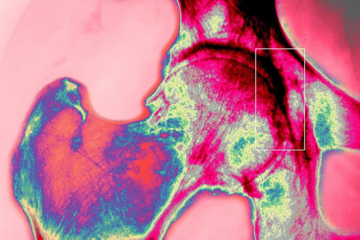 Hip Osteoarthritis, X-Ray, Coxarthrosis, Arthrosis Of Right Hip, Frontal X-Ray Of Hip