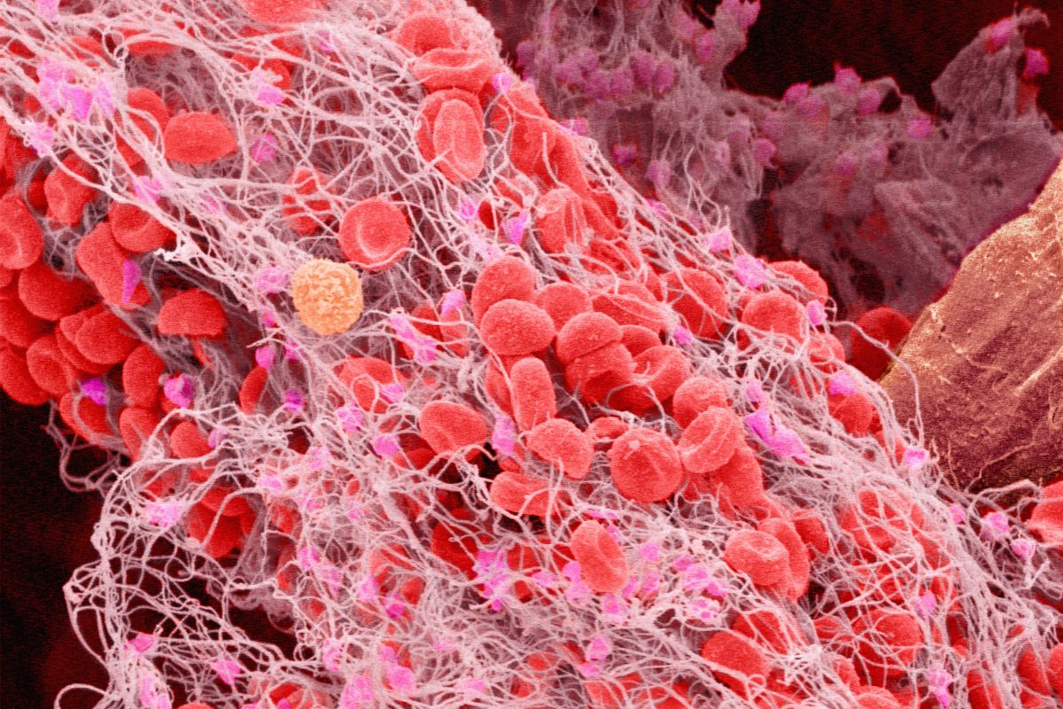 Scanning electron micrograph of a blood clot in human blood, magnification x2000