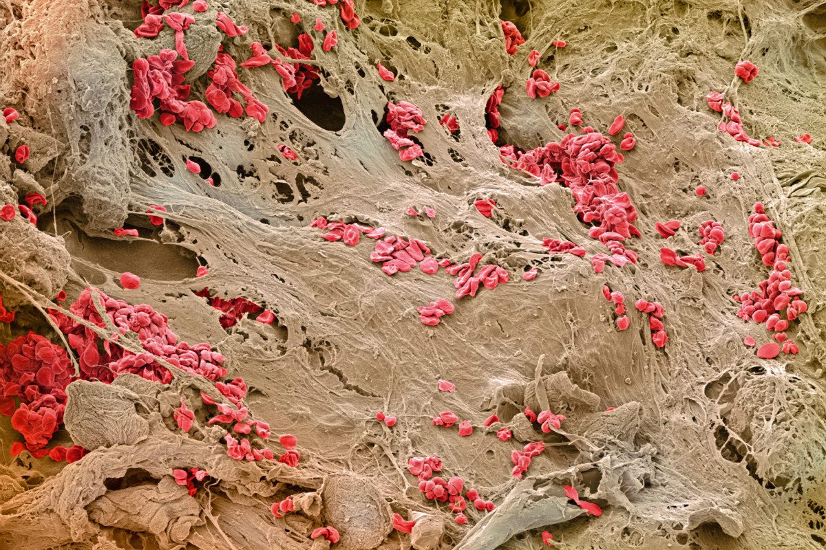  A healing wound on the skin, as seen under a scanning electron microscope. The red blobs are blood cells trapped in a mesh of the protein fibrin, which helps to form a clot and prevent further bleeding 