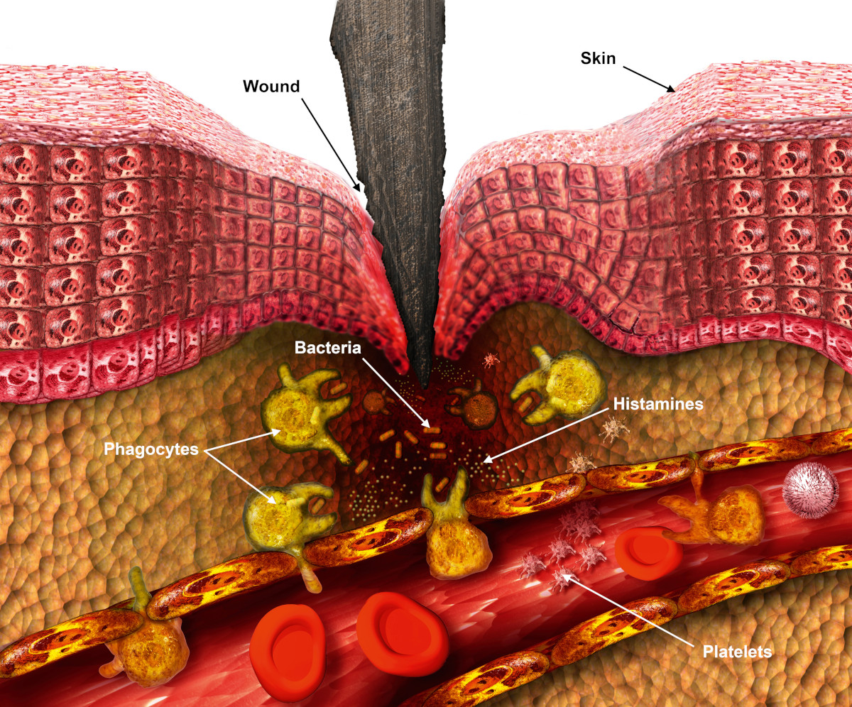Illustration of the body responding to a skin puncture. Inflammatory response. Damaged tissue releases histamines into the area, causing blood vessels (foreground) to become porous. Phagocytes move through the capillary walls to attack bacteria and clean up cellular debris. Platelets move to the wound to cause blood clotting.