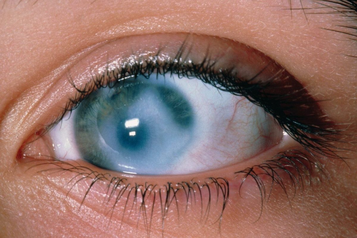 Close up photo of an eye suffering from glaucoma