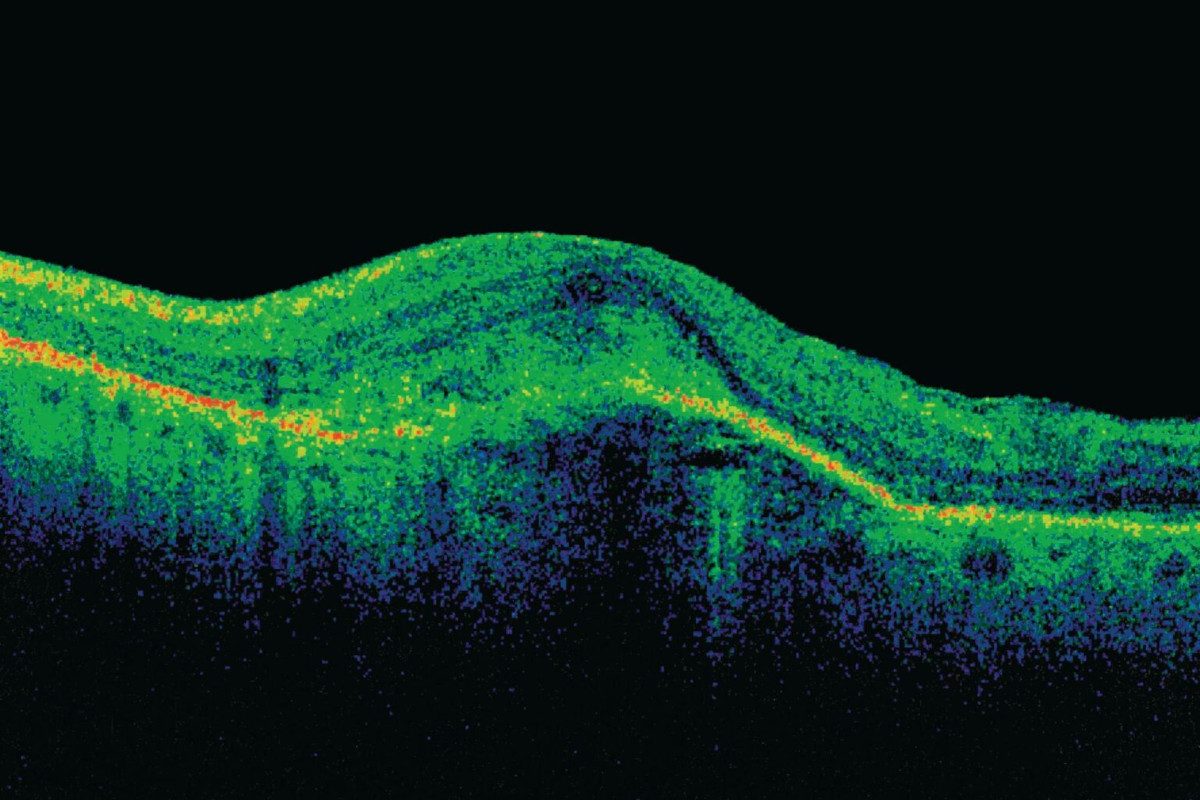 A scan showing age-related macular degeneration