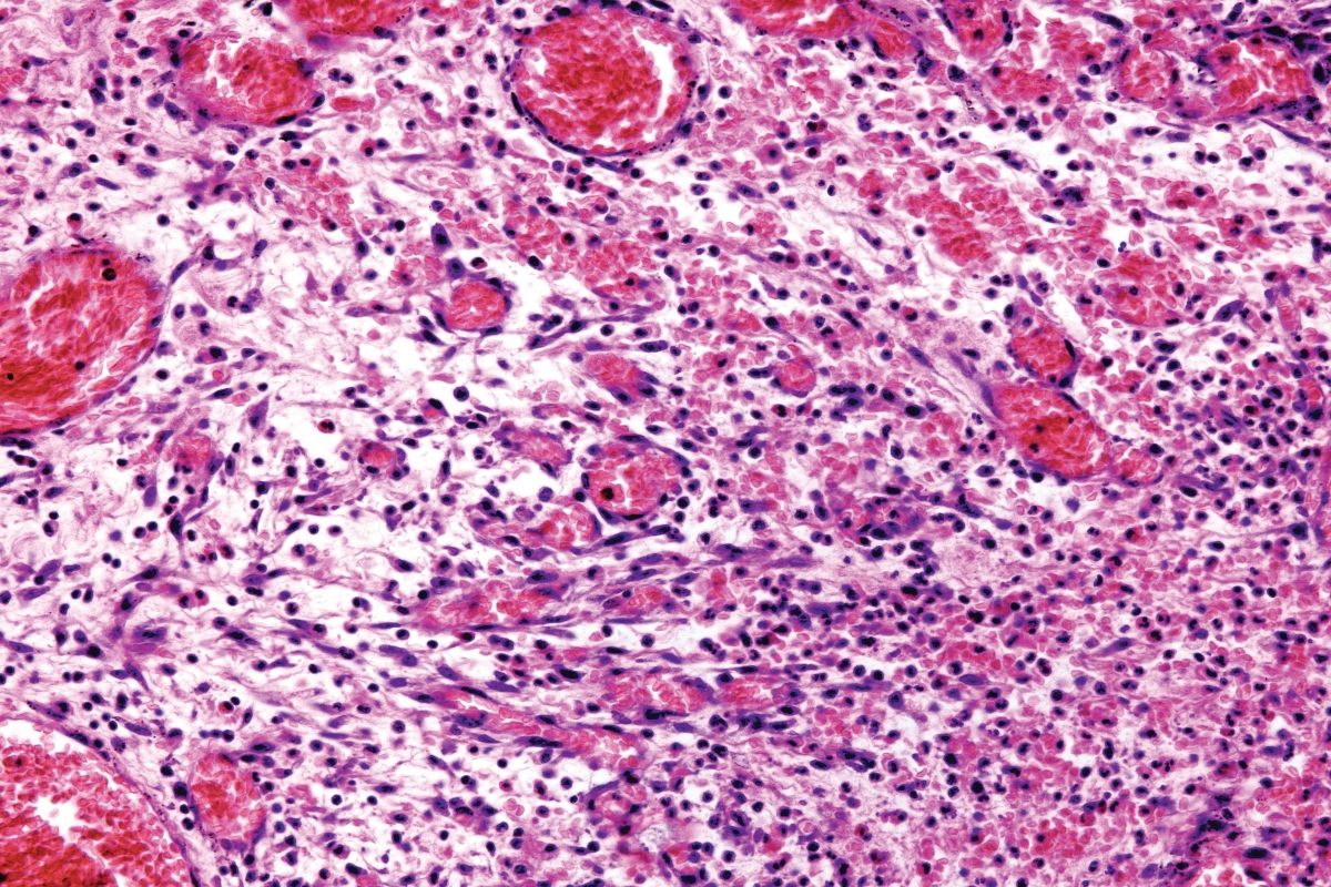 An image of acute inflammation taking place in connective tissue