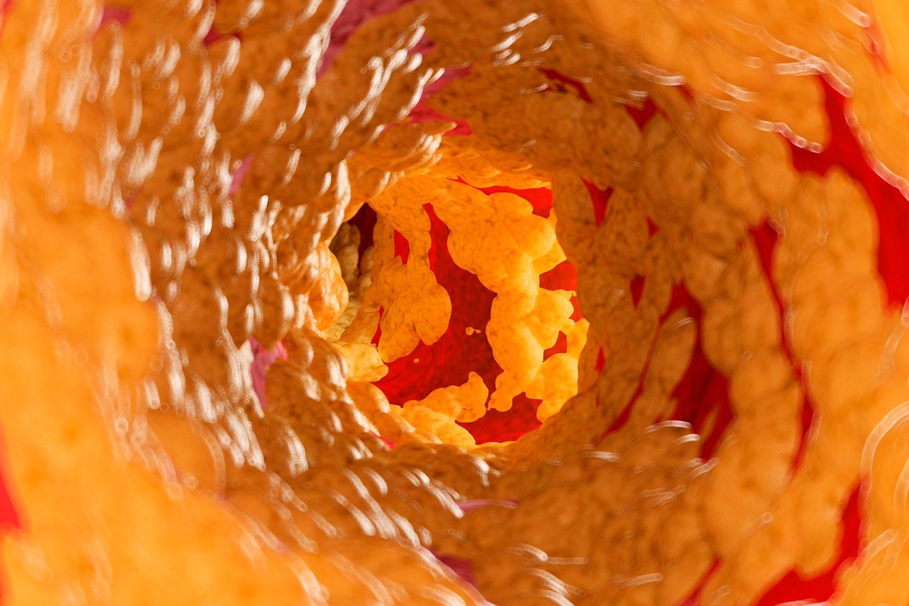 Artery wall covered in yellow cholesterol
