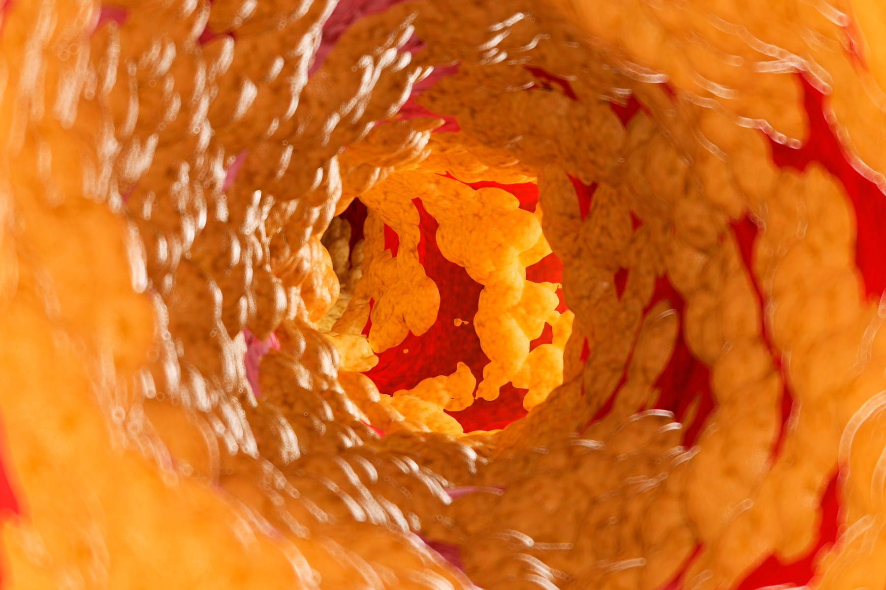 Artery wall covered in yellow cholesterol