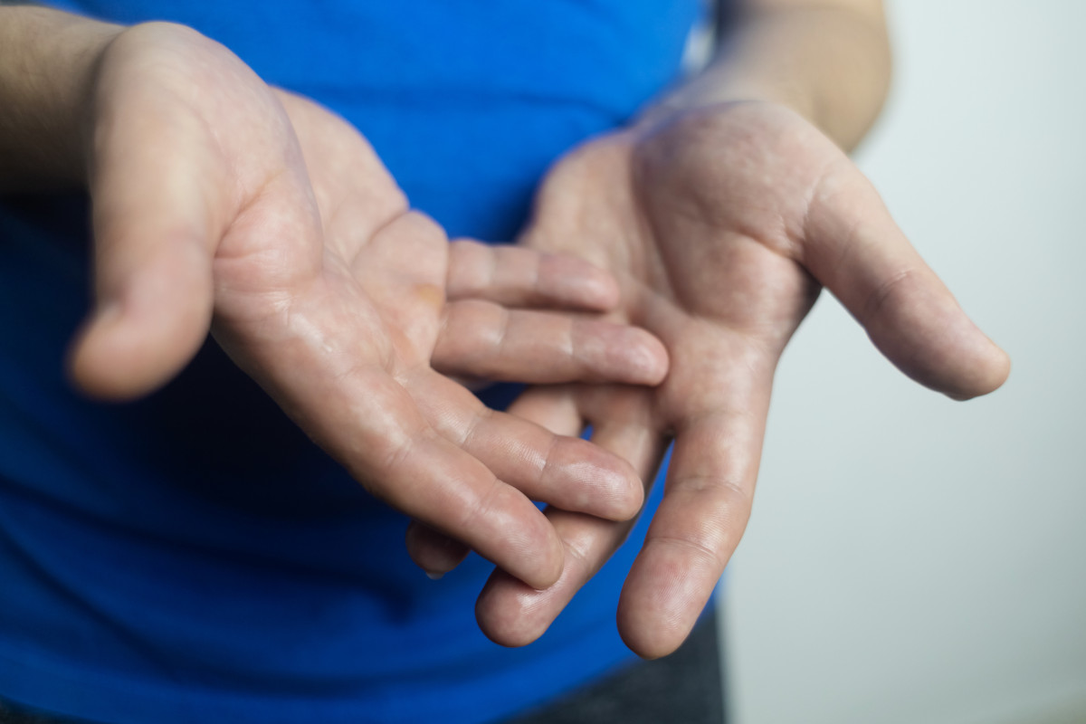 A man suffers from palmar hyperhidrosis