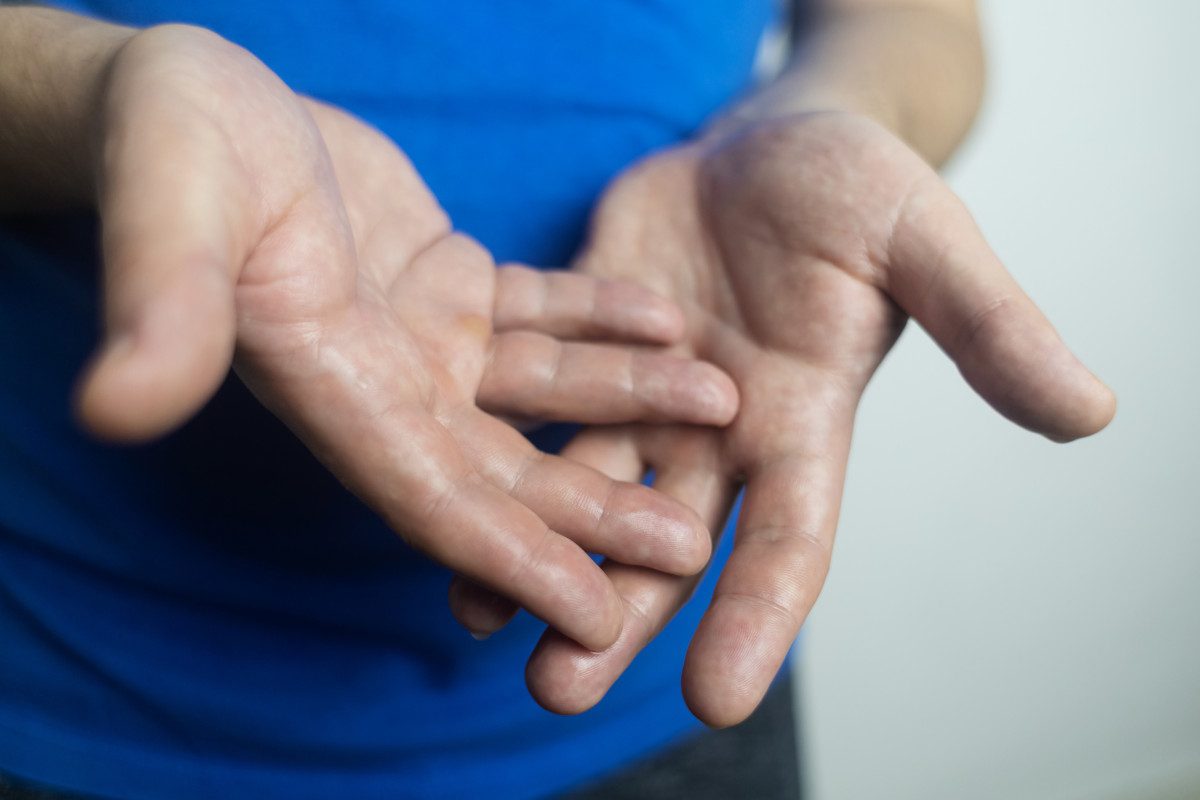 A man suffers from palmar hyperhidrosis