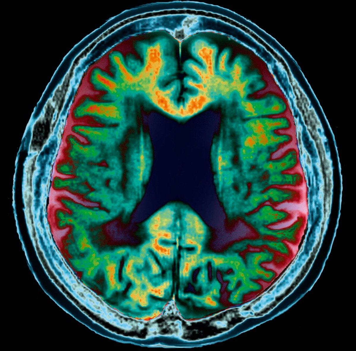 An MRI scan of a brain with Alzheimer’s. The condition destroys brain tissue, leading to abnormally deep folds and enlarged fluid-filled ventricles (centre, black) 