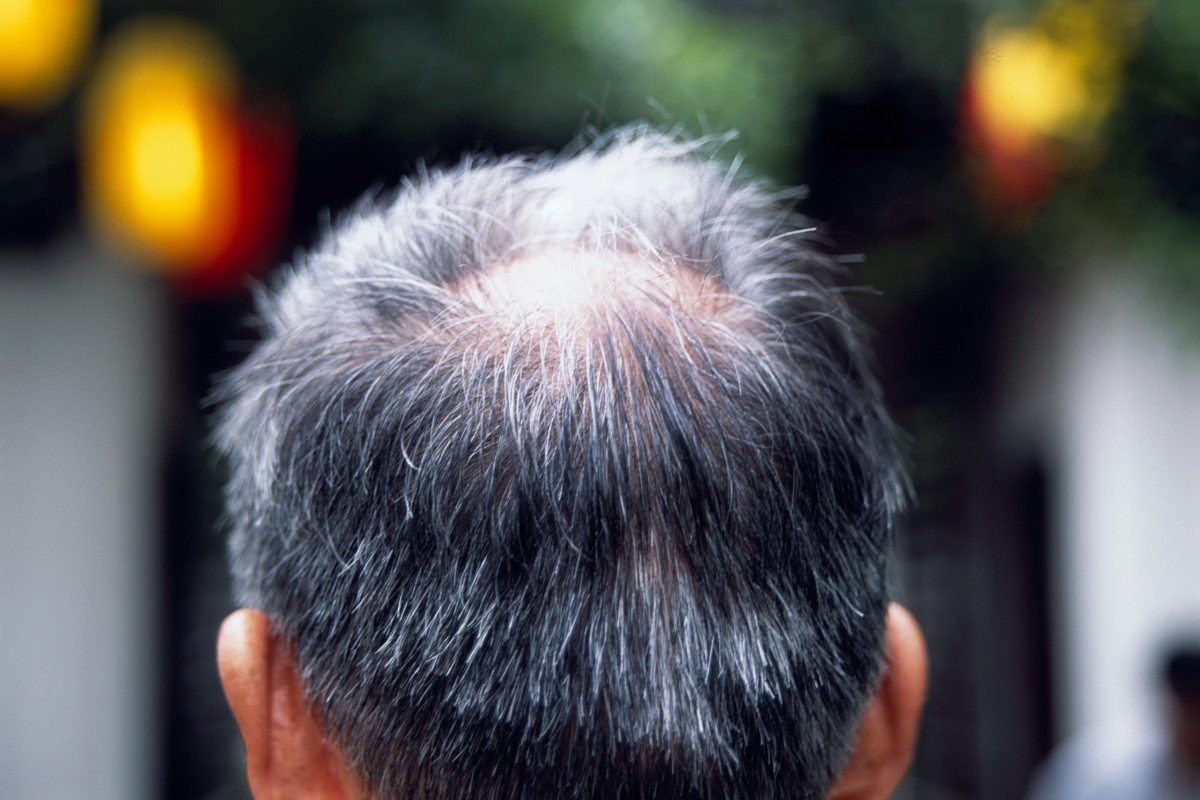 Photo showing the back of a balding man's head. The crown area of his scalp is losing hair